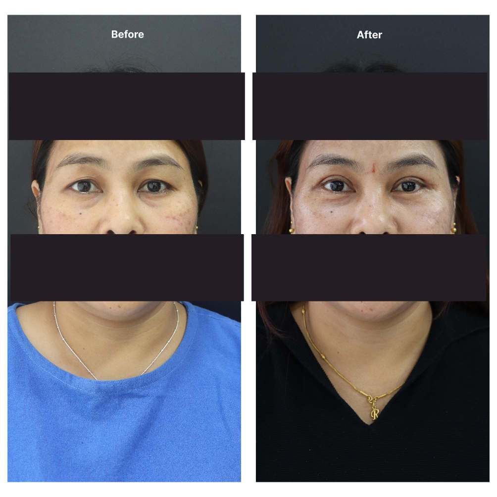 Eyelid Surgery KOQ10